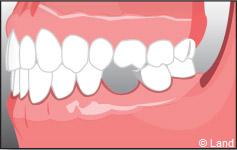 Pour remplacer les dents manquantes