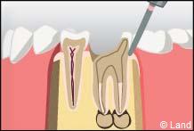 traitement radiculaire